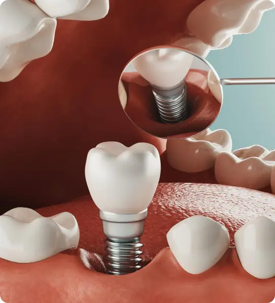 Dental Implants