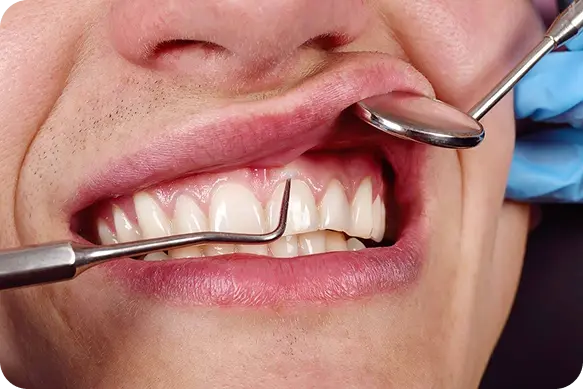 Gum Treatment