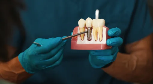 Implant-Supported Bridge
