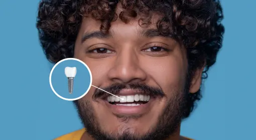 Single Tooth Implant