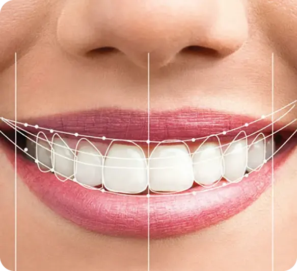Smile Makeover