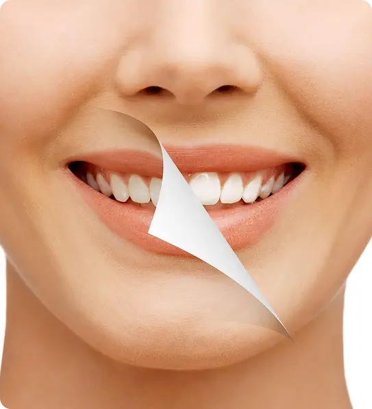 Smile Makeover