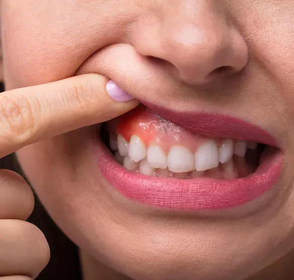 Gum Treatment
